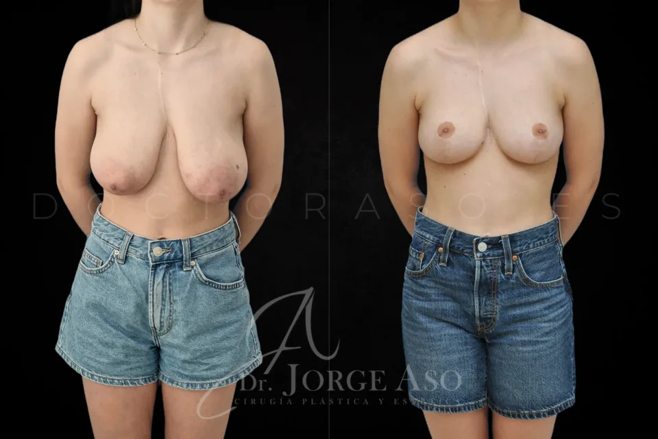 Mastopexia antes y después, sin prótesis, vista frontal