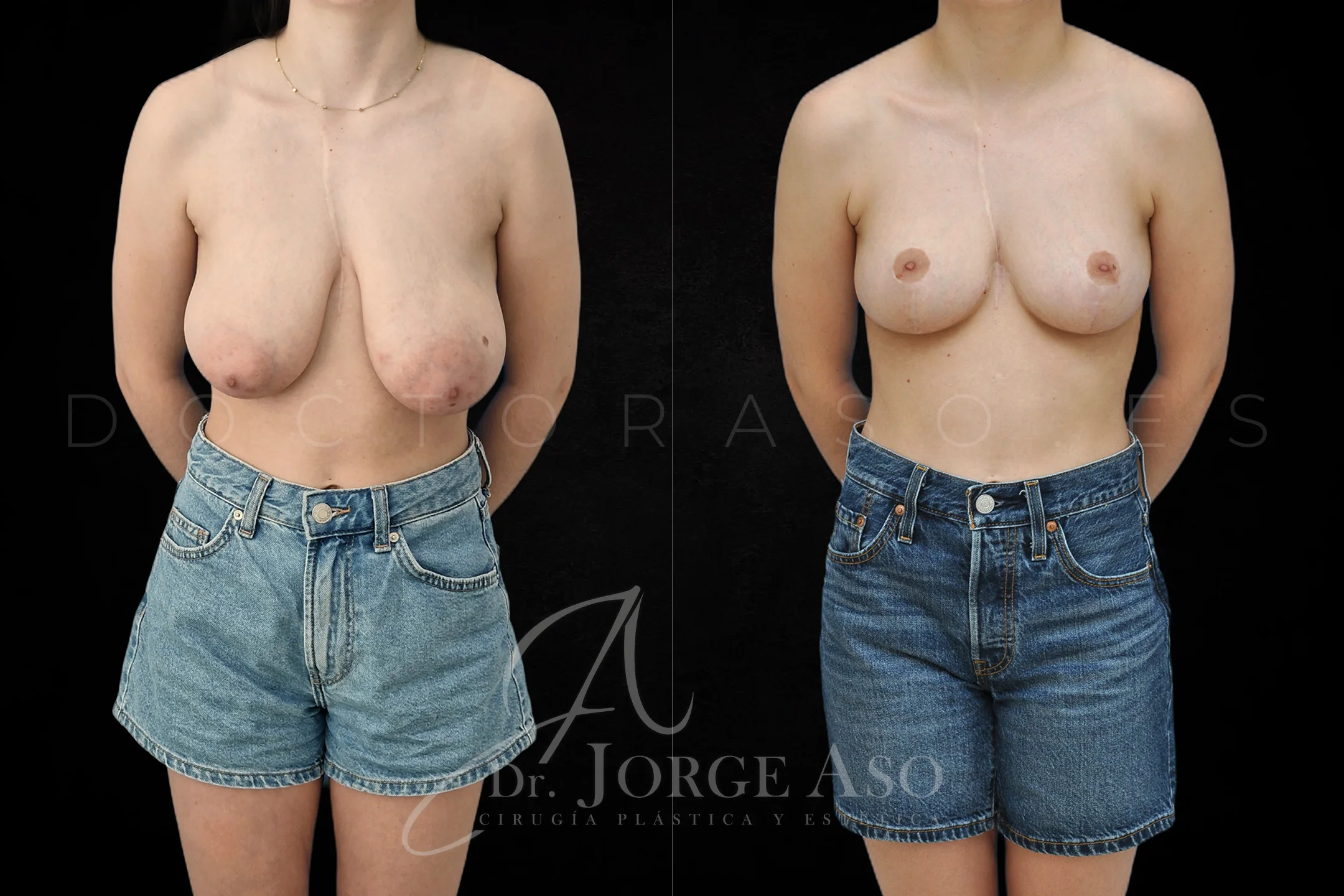 Mastopexia antes y despues sin protesis vista frontal