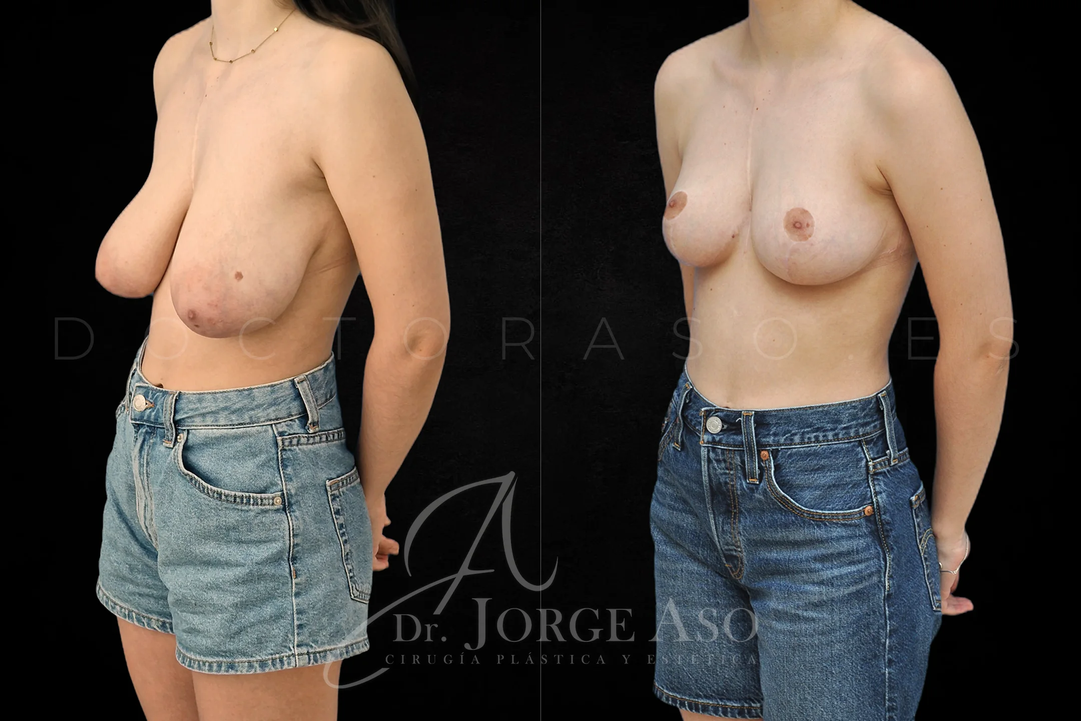 Mastopexia antes y despues sin protesis vista oblicua