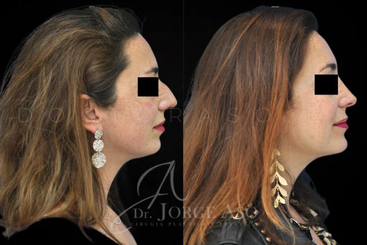 Caso real de mentoplastia con rinoplastia, perfil lateral antes y después