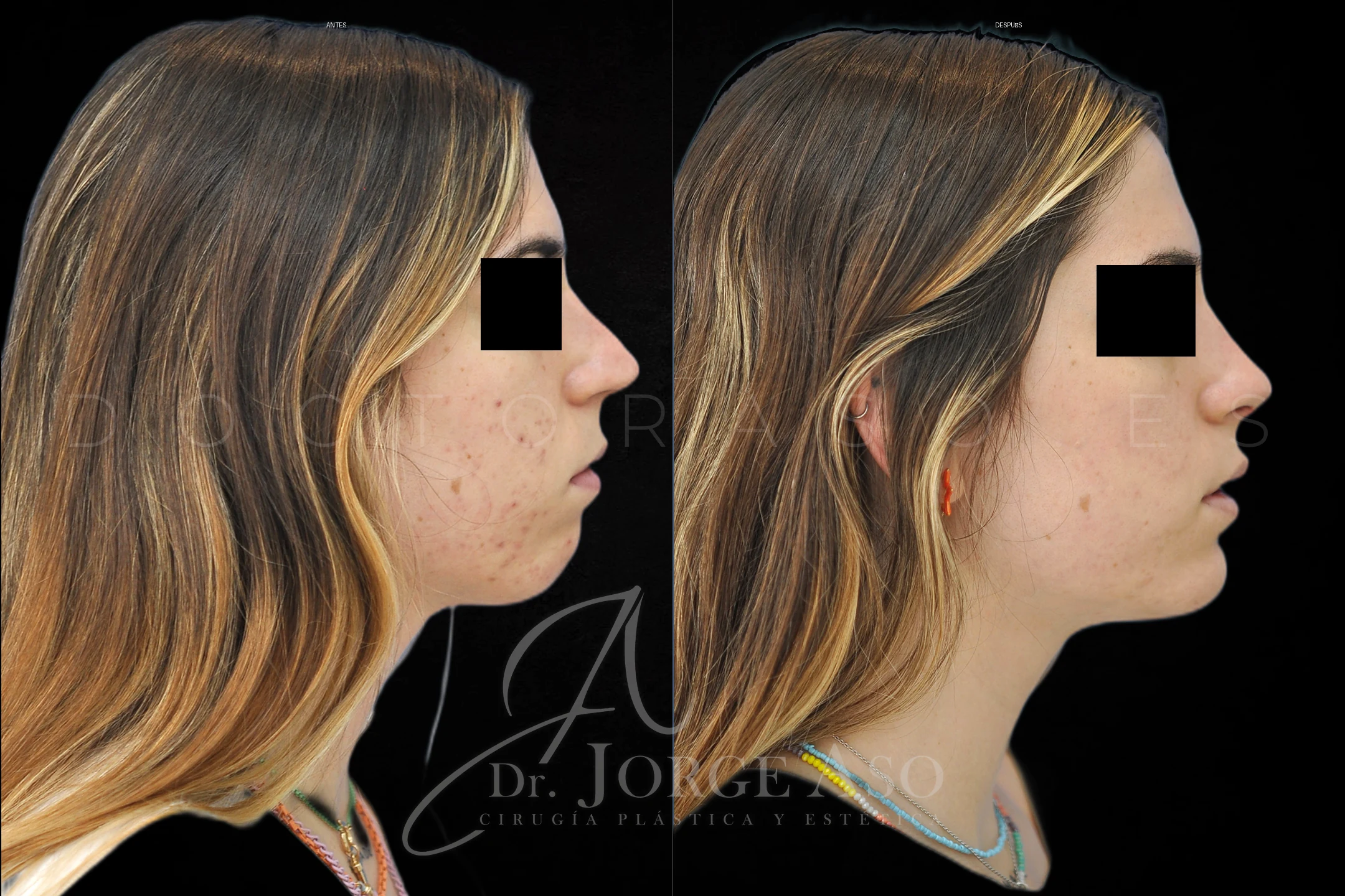 Mentoplastia antes y despues combinada con rinoplastia vista lateral