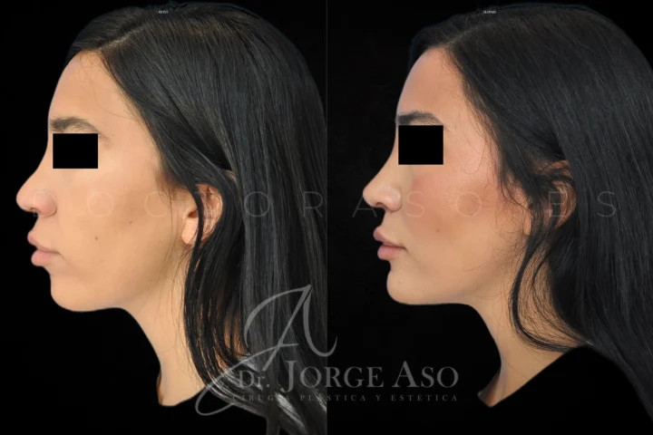 Antes y después de rinoplastia y mentoplastia en vista lateral