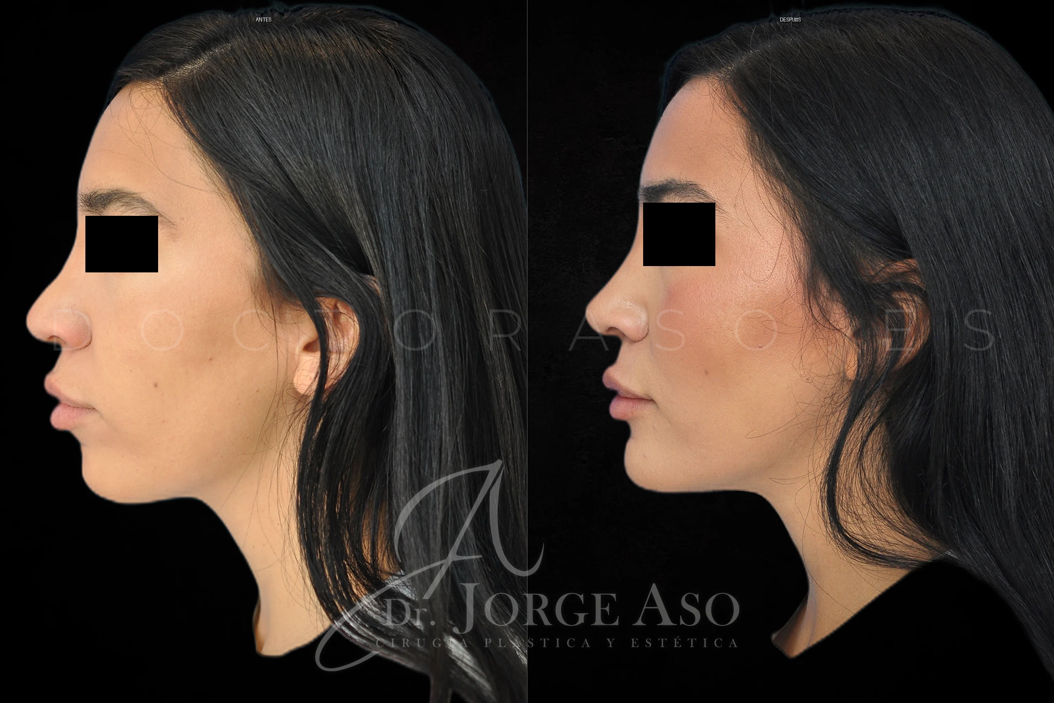 Mentoplastia antes y despues combinada con rinoplastia vista lateral