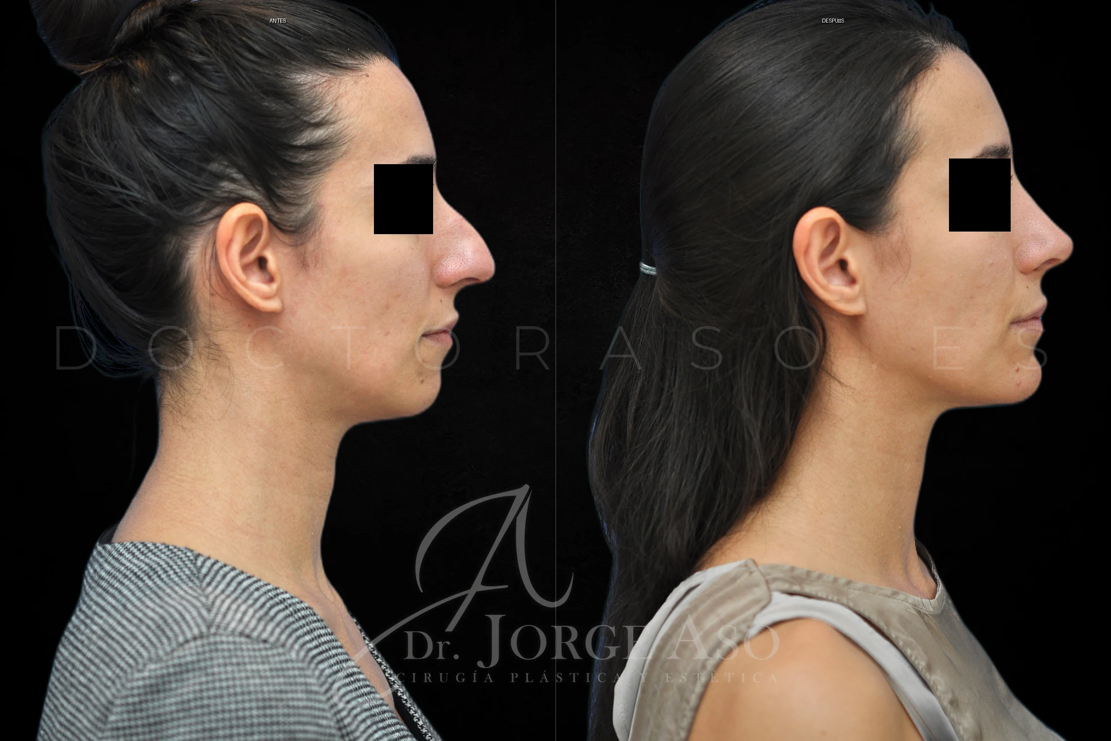 Mentoplastia antes y despues combinada con rinoplastia vista lateral