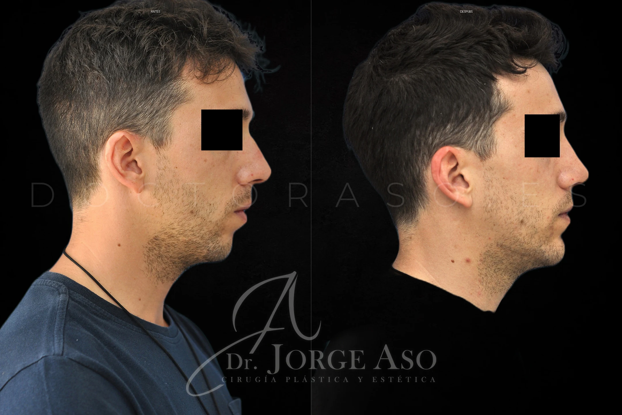 Mentoplastia antes y despues combinada con rinoplastia vista lateral