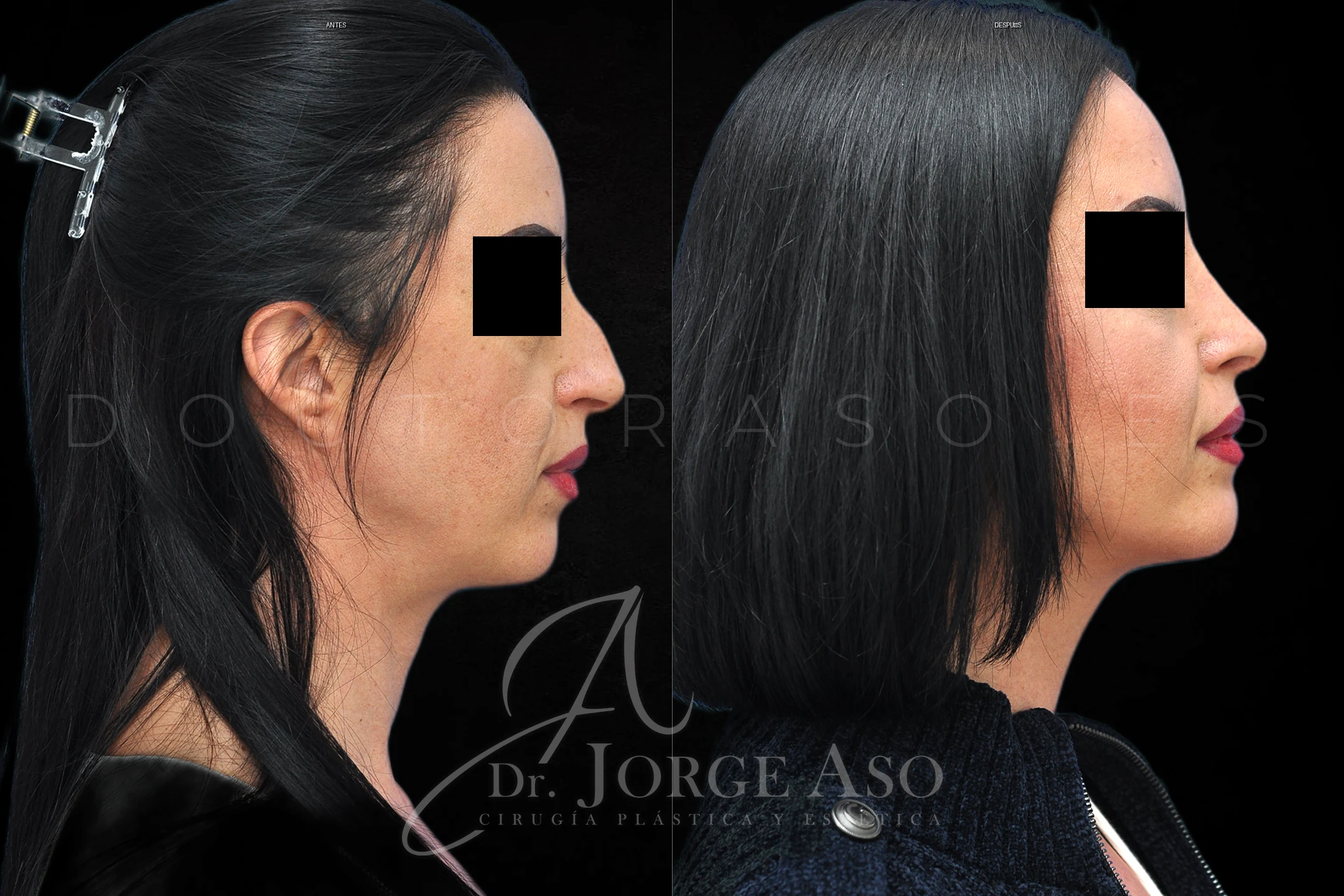 Mentoplastia antes y despues combinada con rinoplastia vista lateral
