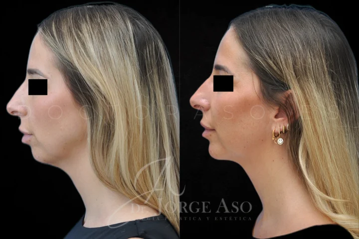 Caso real de mentoplastia, perfil lateral antes y después