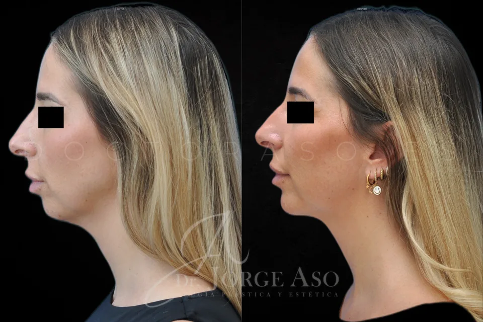 Caso real 02 de mentoplastia, vista lateral, antes y después