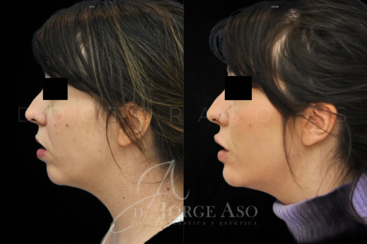 Caso real de avance de mentón, perfil lateral antes y después