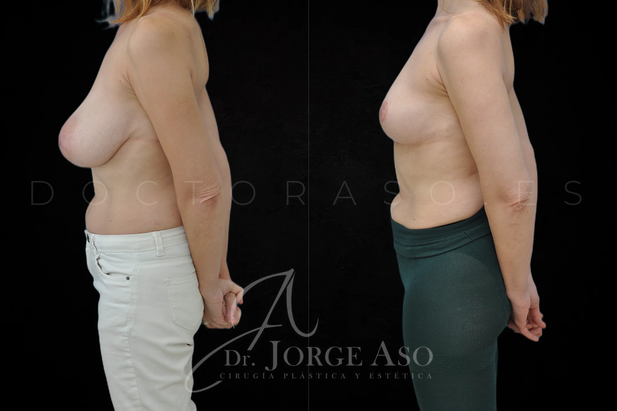 Reduccion de pecho antes y despues vista lateral
