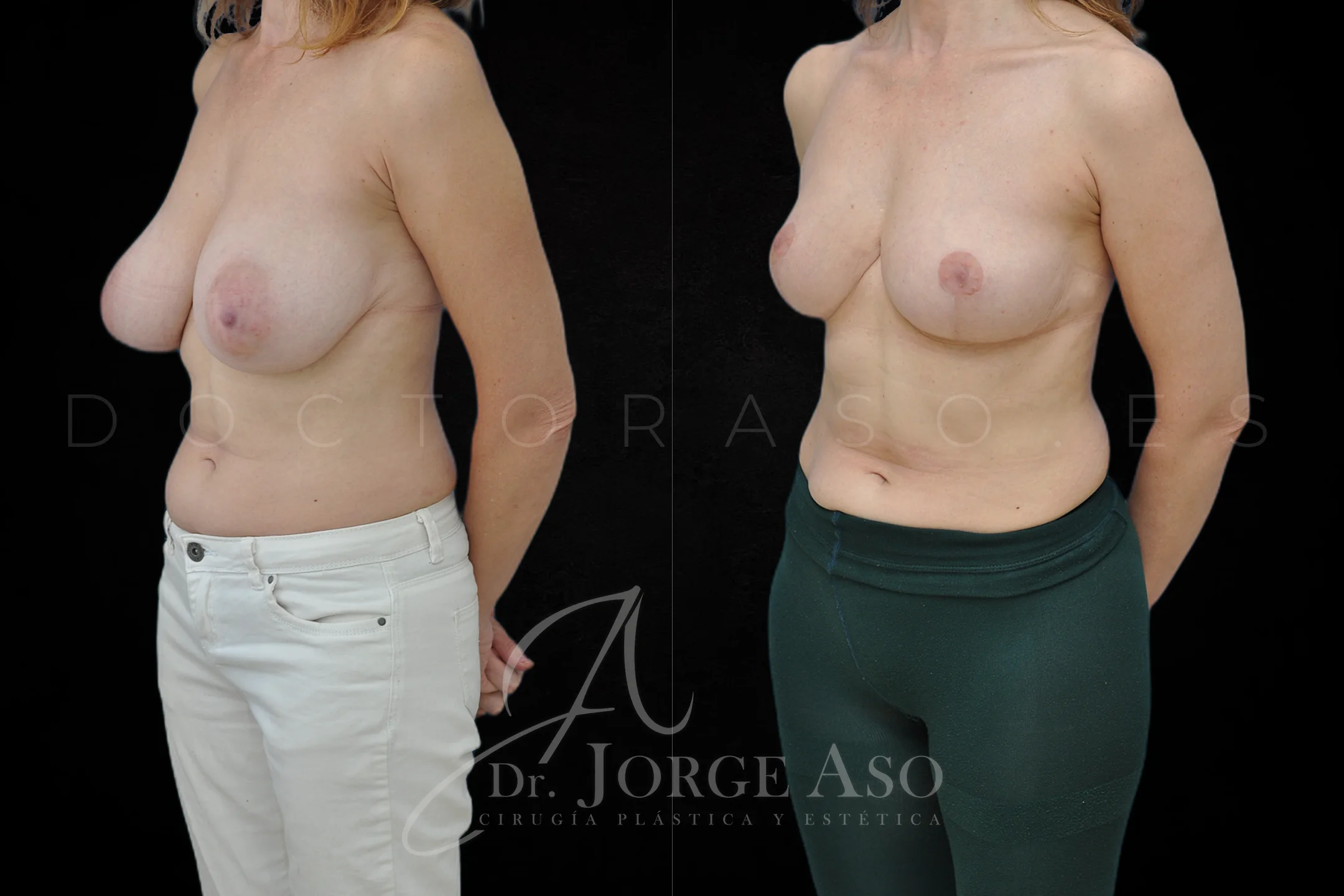Reduccion de pecho antes y despues vista oblicua