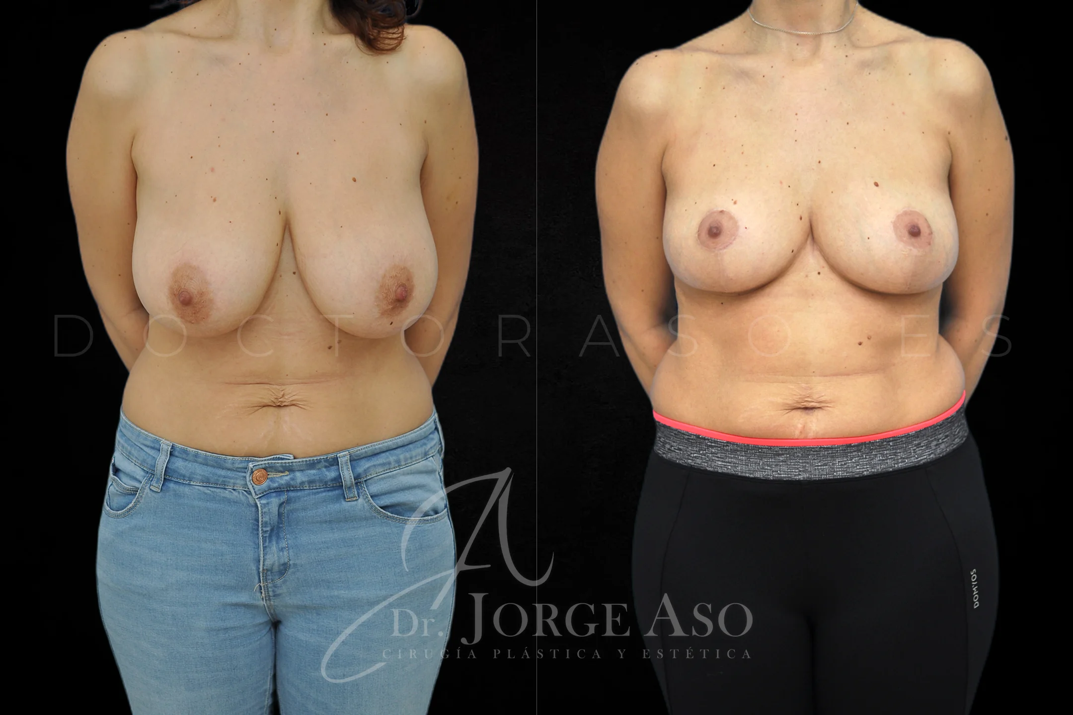 Reduccion de pecho antes y despues vista frontal