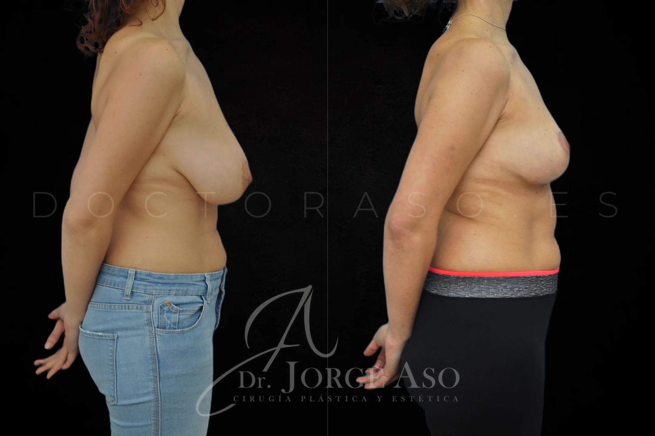 Reduccion de pecho antes y despues vista lateral