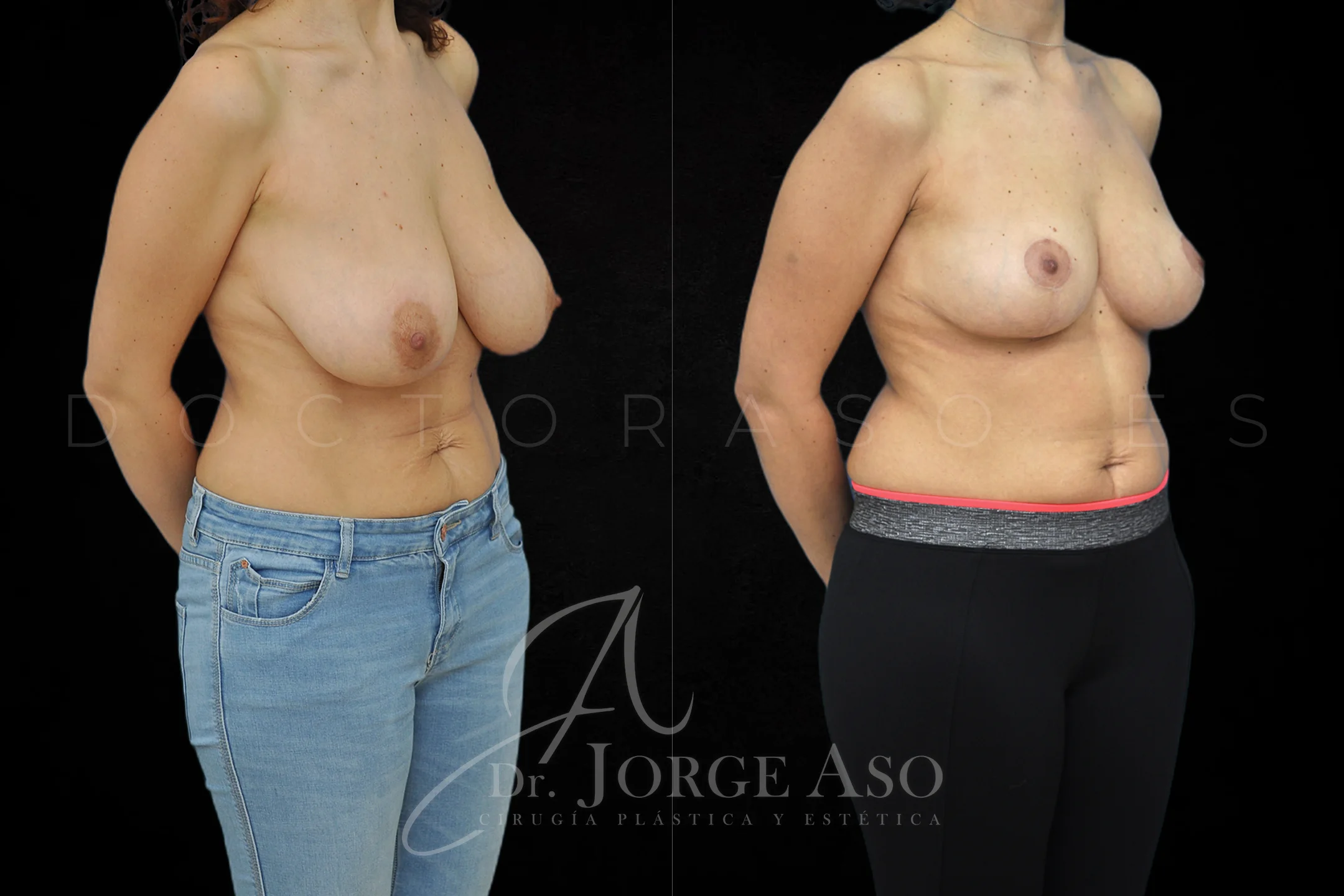 Reduccion de pecho antes y despues vista oblicua