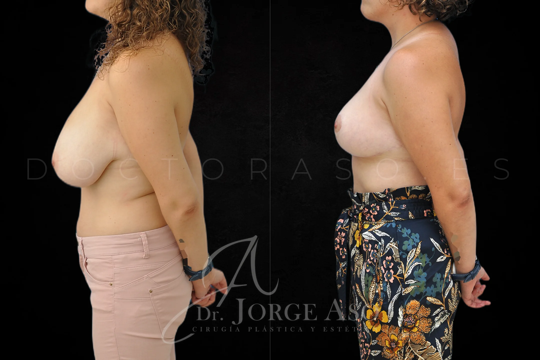 Reduccion de pecho antes y despues vista lateral
