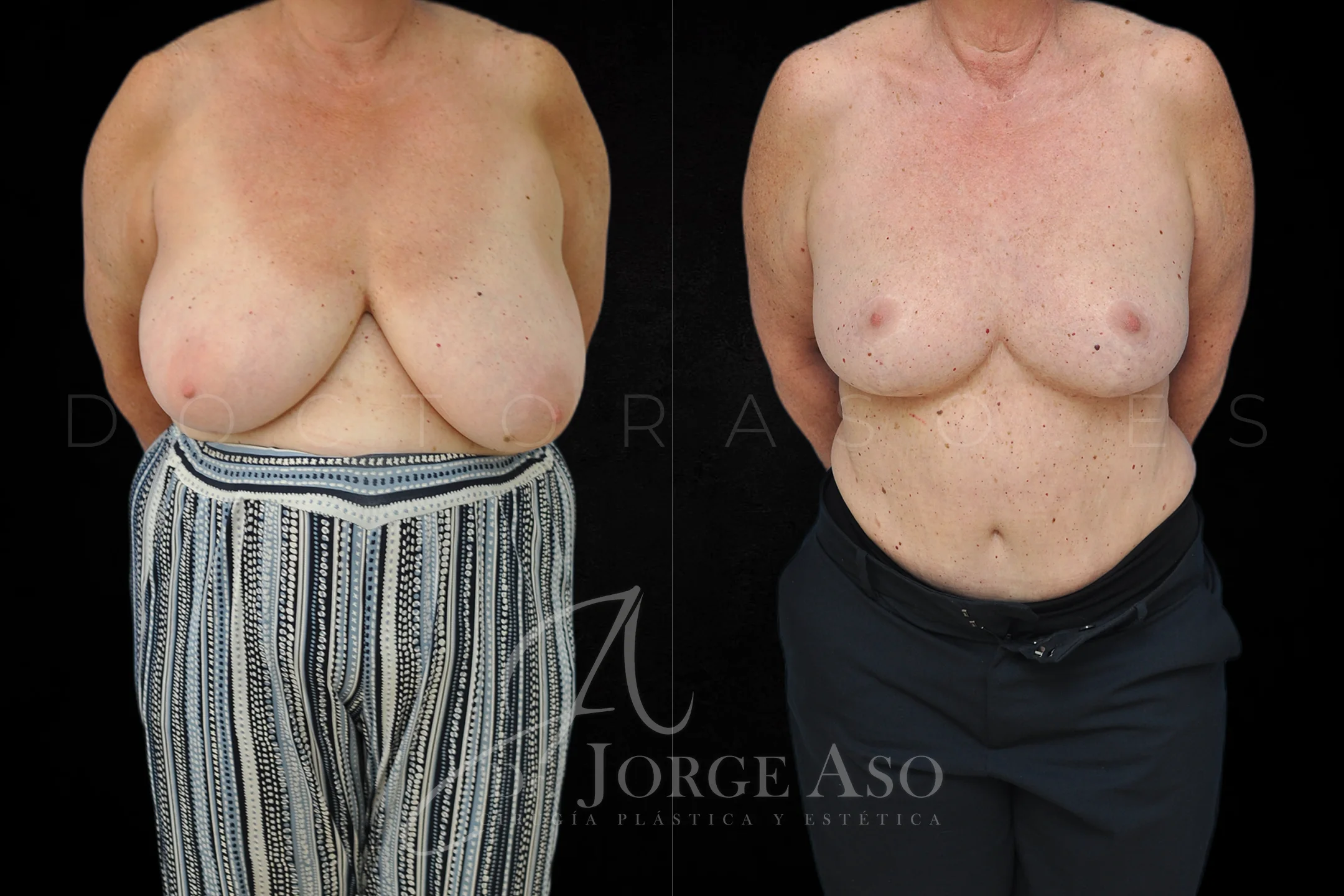 Reduccion de pecho antes y despues vista frontal