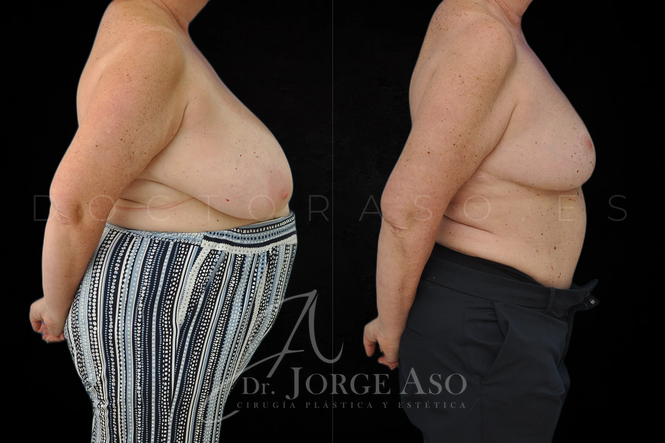 Reduccion de pecho antes y despues vista lateral