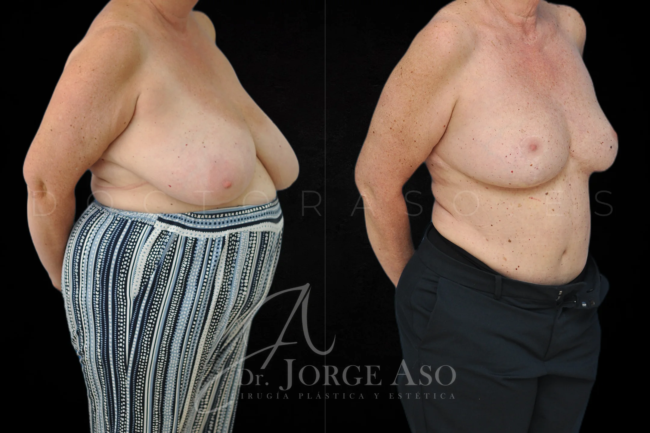 Reduccion de pecho antes y despues vista oblicua
