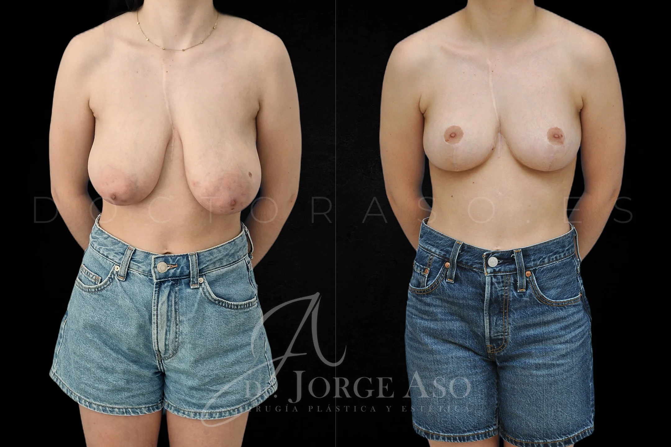 Reduccion de pecho antes y despues vista frontal