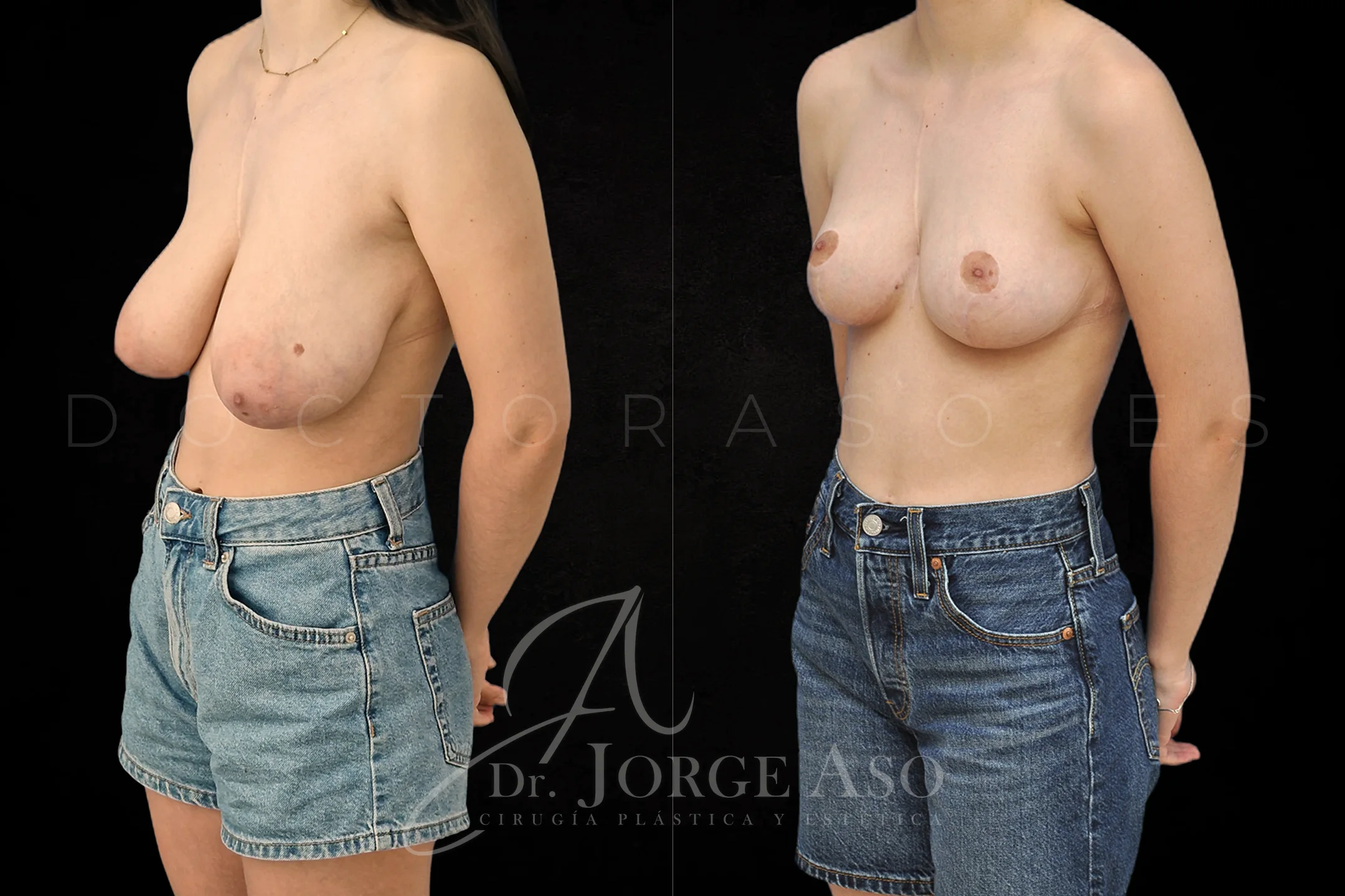 Reduccion de pecho antes y despues vista oblicua