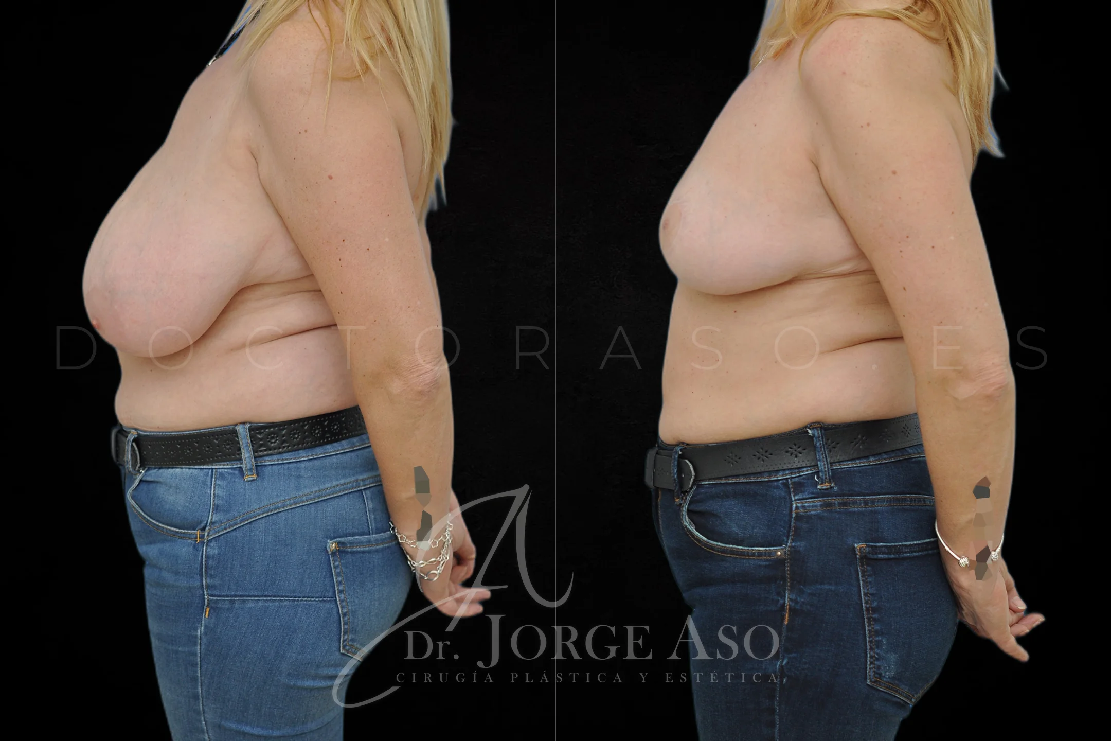 Reduccion de pecho antes y despues vista lateral