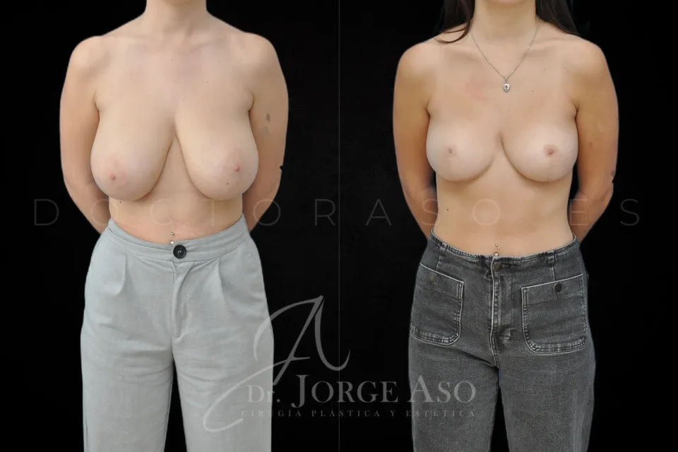 Caso real 02 de reducción de pecho, vista frontal, antes y después
