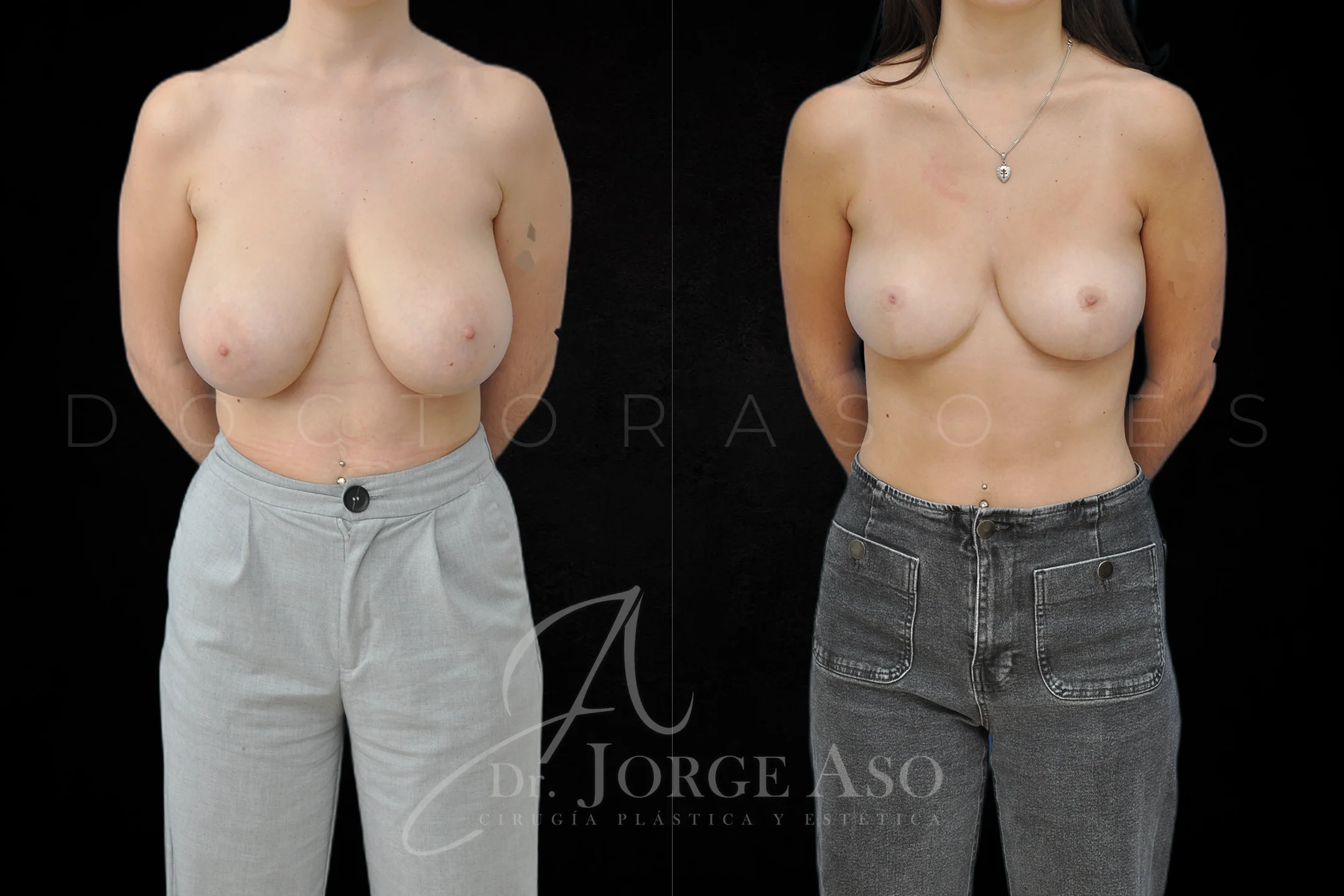 Reduccion de pecho antes y despues vista frontal
