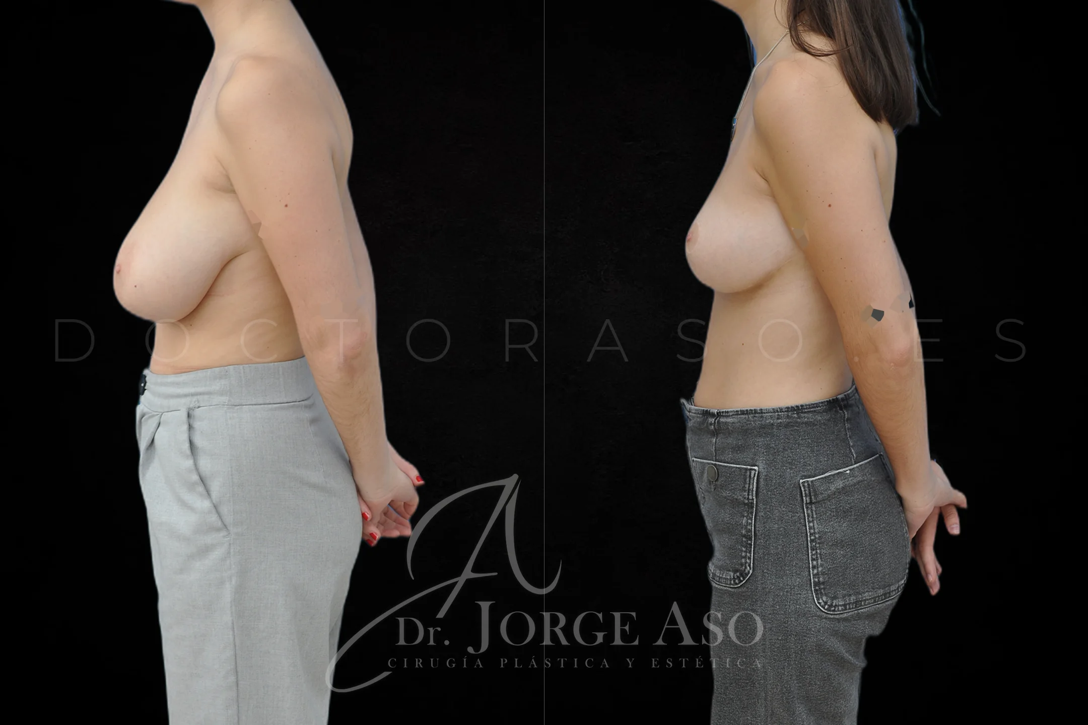 Reduccion de pecho antes y despues vista lateral